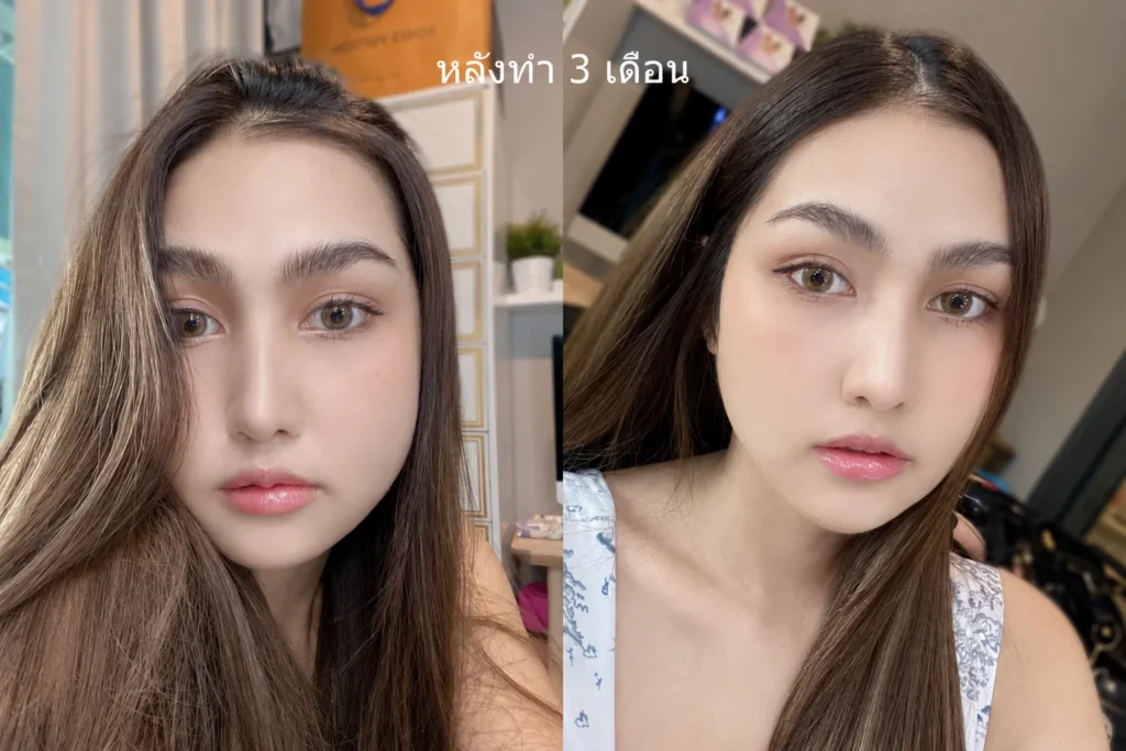 หลังยุบโหนกแก้ม-3-เดือน