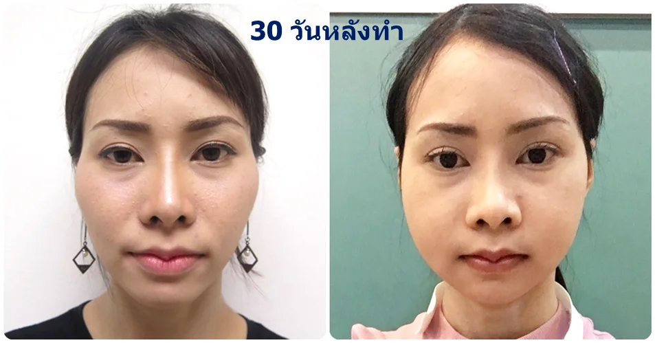หลังทำ30วัน-รีวิวยุบโหนกแก้ม-กรอโหรกแก้ม-ทำหน้าเรียว