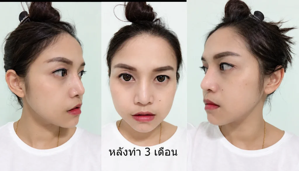 หลังทำ 3 เดือน ปรับโครงหน้า ตัดกราม กรอกราม