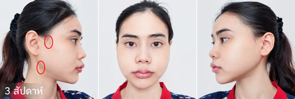 หลังทำ 3 สัปดาห์ ยุบโหนก ตัดกราม กรอกราม แก้ไขคางเล็ก