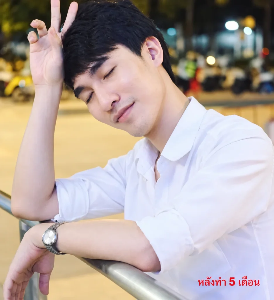 หลังยุบโหนกตัดกราม 5 เดือน