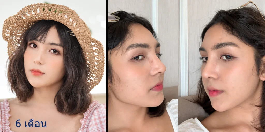รูปหลังยุบโหนกแก้ม-ตัดกราม-วีไลน์-6เดือน
