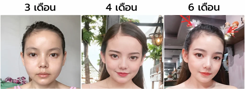หลังตัดกราม6เดือน