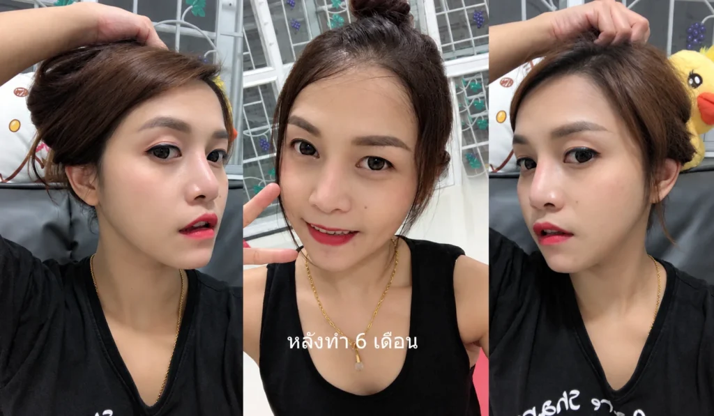 หลังทำ 6 เดือน ปรับโครงหน้า ตัดกราม กรอกราม