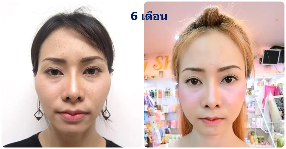 รูปหลังทำ6เดือน-รีวิวยุบโหนกแก้ม-กรอโหรกแก้ม-ทำหน้าเรียว