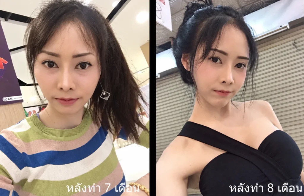 หลังทำ7เดือน-รีวิวยุบโหนกแก้ม-กรอโหรกแก้ม-ทำหน้าเรียว