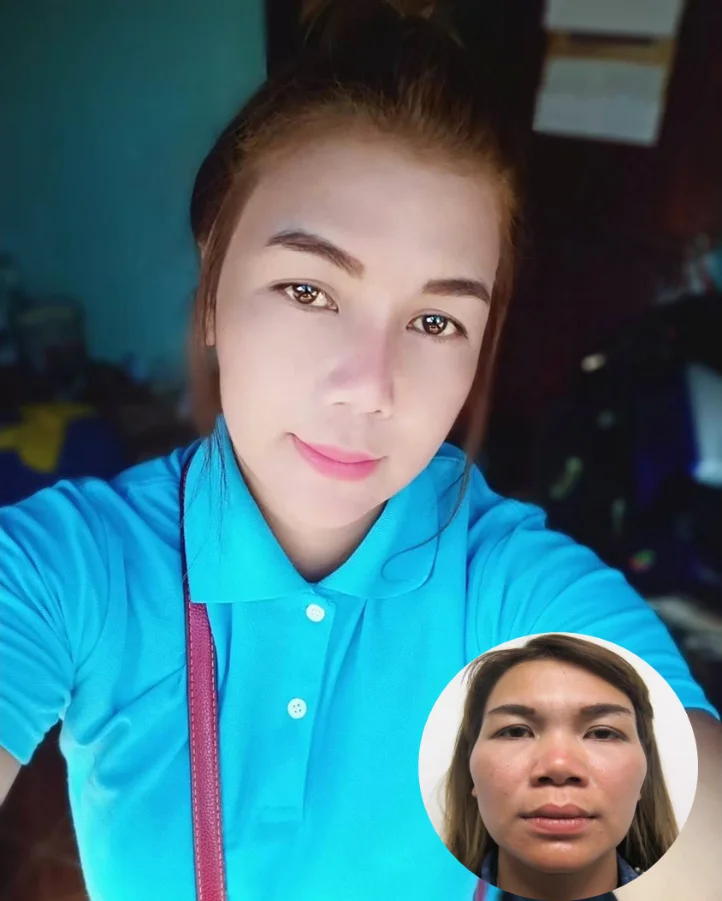 รูปหลังยุบโหนกแก้ม-ตัดกราม-กรอกราม-วีไลน์