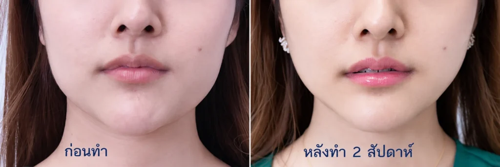 ก่อนทำ-หลังทำ2สัปดาห์ ศัลยกรรมตัดกราม กรอกราม