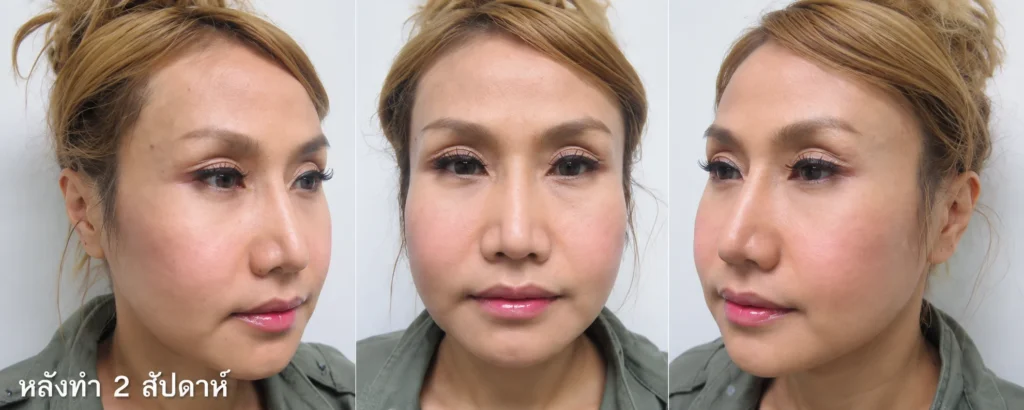 หลังยุบโหนกตัดกราม 2 สัปดาห์