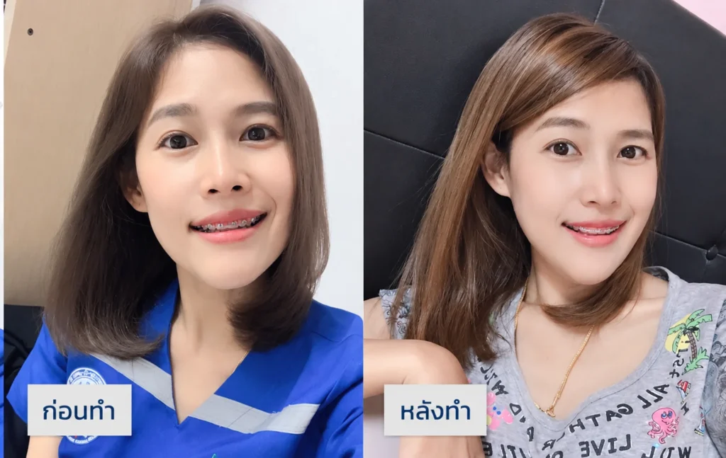 รีวิวหลังทำยุบโหนกแก้ม ตัดกราม กรอกราม วีไลน์
