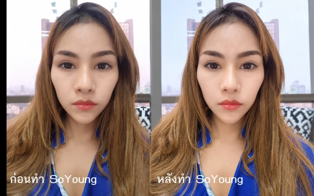 ปัญหาก่อนทำ โหนกสูง แก้มตอบ