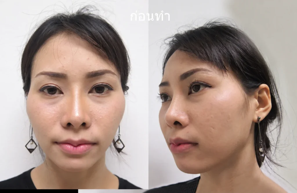 รูปก่อนทำศัลยกรรมยุบโหนกแก้ม-ลดโหนก-กรอโหนกแก้ม