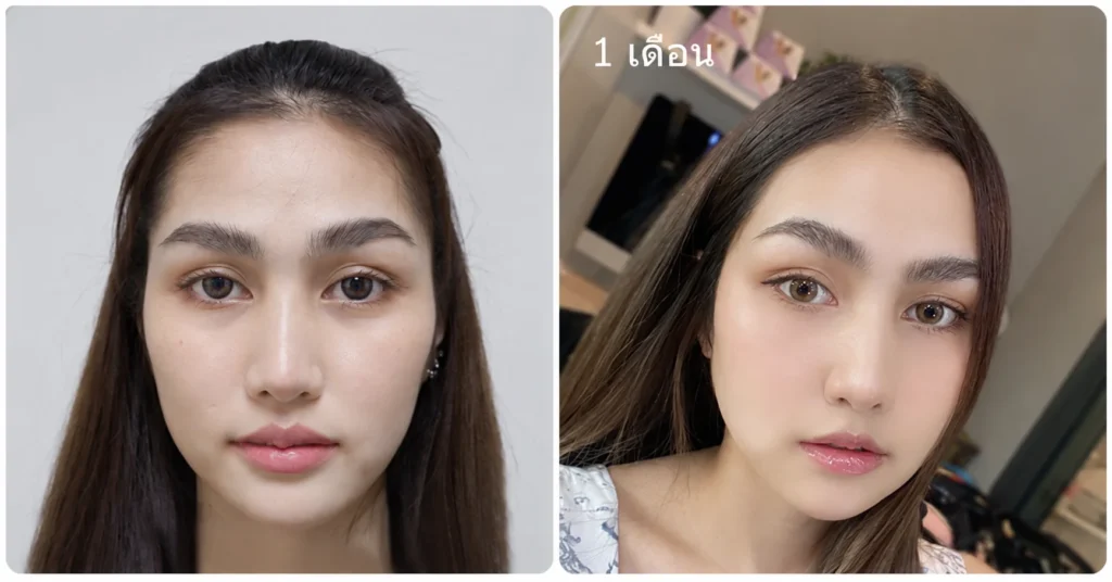 หลังยุบโหนกแก้ม1 เดือน