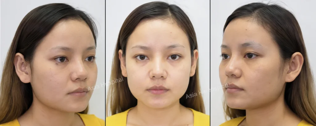 รูปก่อนตัดกราม-กรอกราม-วีไลน์