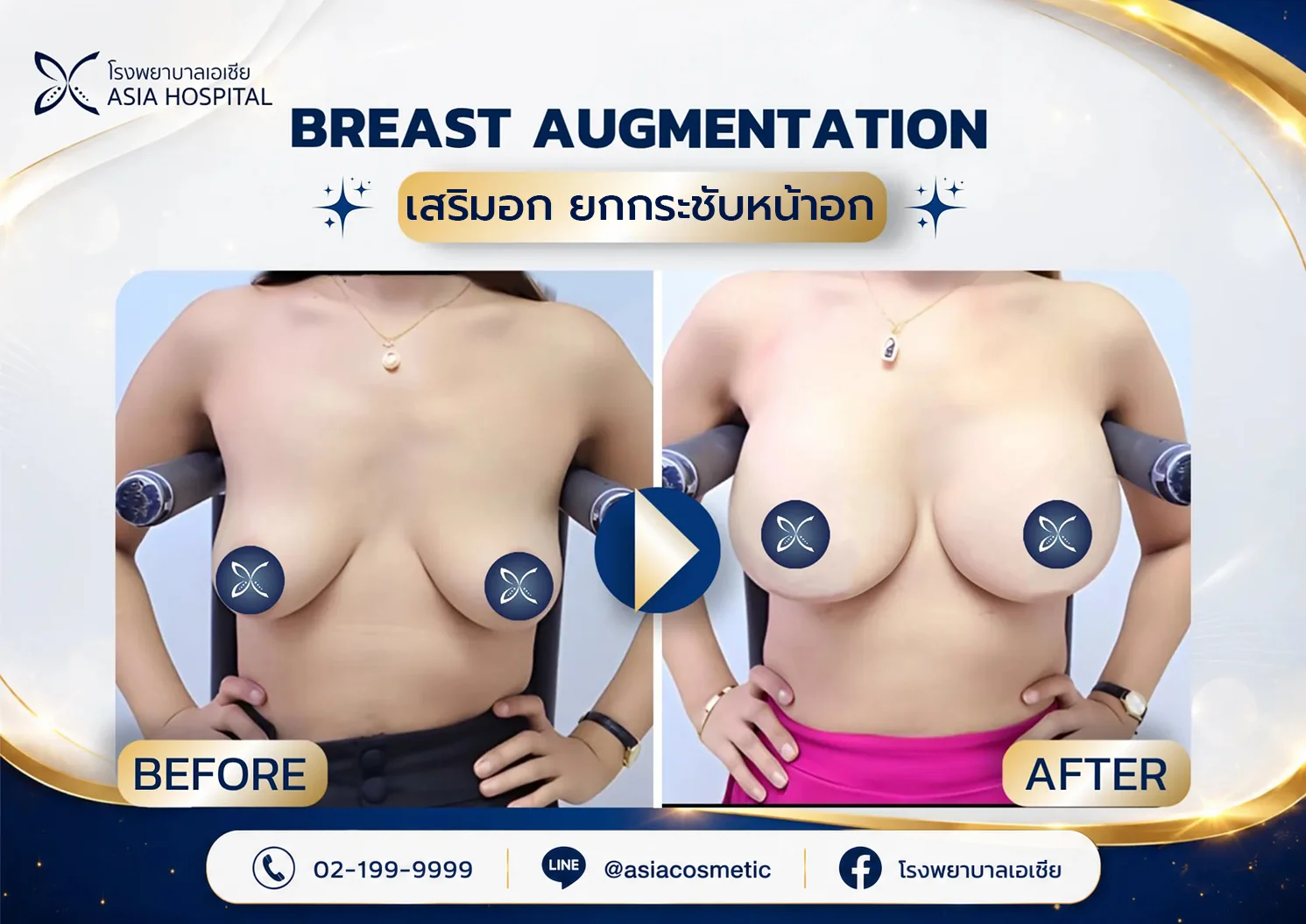 ยกกระชับหน้าอก-รีวิวยกกระชับหน้าอก