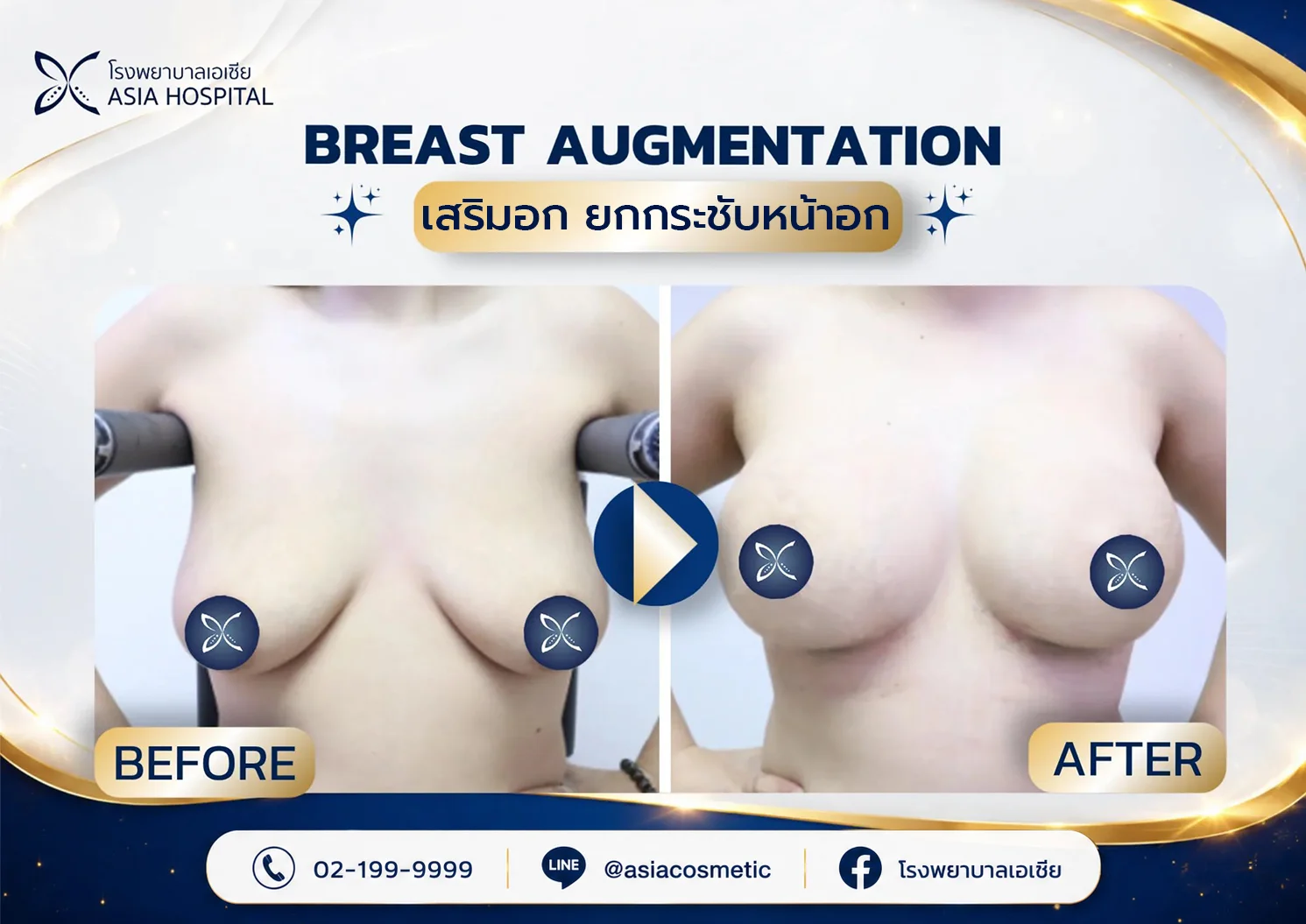 ยกกระชับหน้าอก-รีวิวยกกระชับหน้าอก