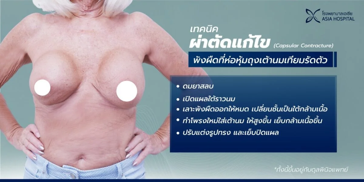 แก้หน้าอก Breast Revision | โรงพยาบาลเอเซีย | โรงพยาบาลเอเซีย แก้หน้าอก-ที่ไหนดี-เลาะพังผืด-แก้ไขหน้าอก