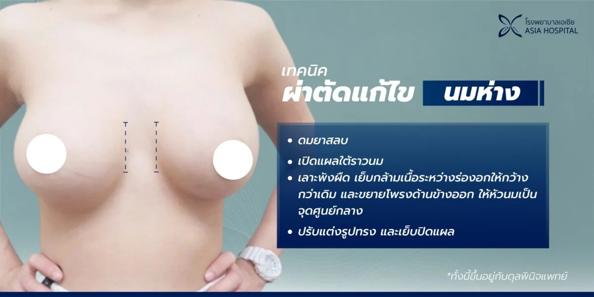 แก้หน้าอก นมห่าง | โรงพยาบาลเอเซีย | โรงพยาบาลเอเซีย แก้หน้าอก-นมห่าง-แก้ไขหน้าอก