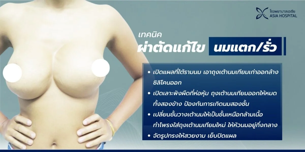 แก้หน้าอก นมแตก/รั่ว | โรงพยาบาลเอเซีย | โรงพยาบาลเอเซีย แก้หน้าอก-ซิลิโคนหน้าอกแตก-แก้ไขหน้าอก