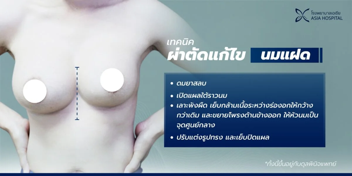 แก้หน้าอก นมแฝด | โรงพยาบาลเอเซีย | โรงพยาบาลเอเซีย แก้หน้าอก-นมแฝด-แก้ไขหน้าอก