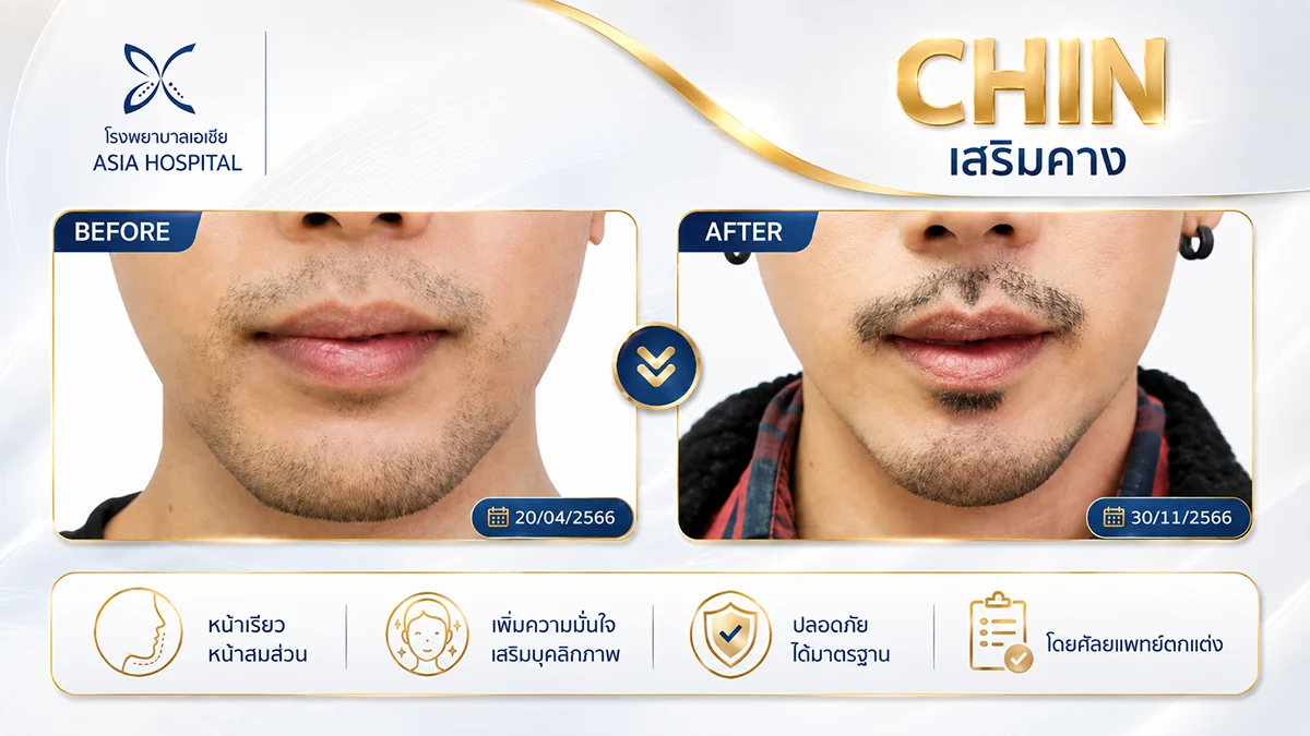 รีวิวเสริมคาง_เสริมคางผู้ชาย
