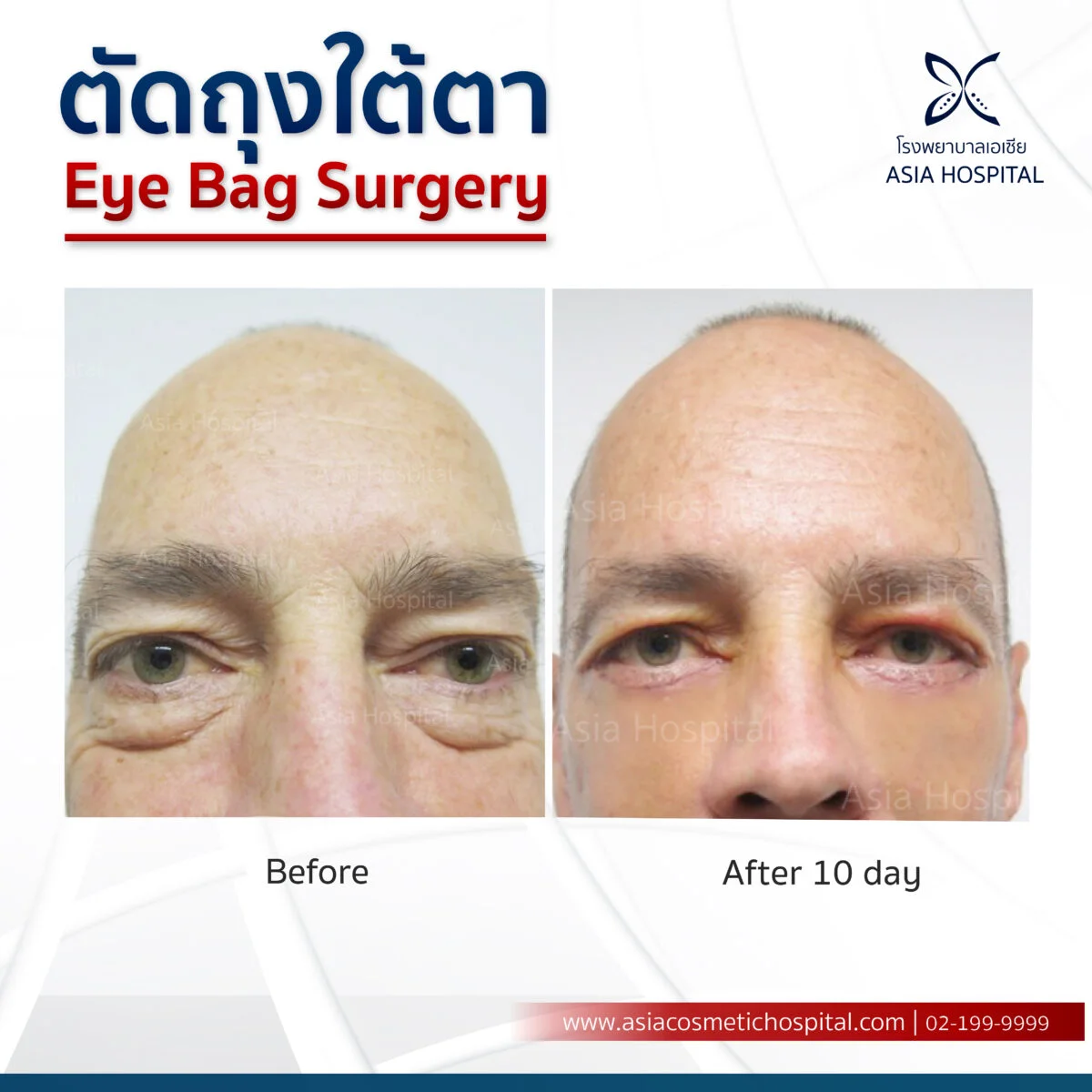 ศัลยกรรมตัดถุงใต้ตาผู้ชาย_รีวิวตัดถุงใต้ตา