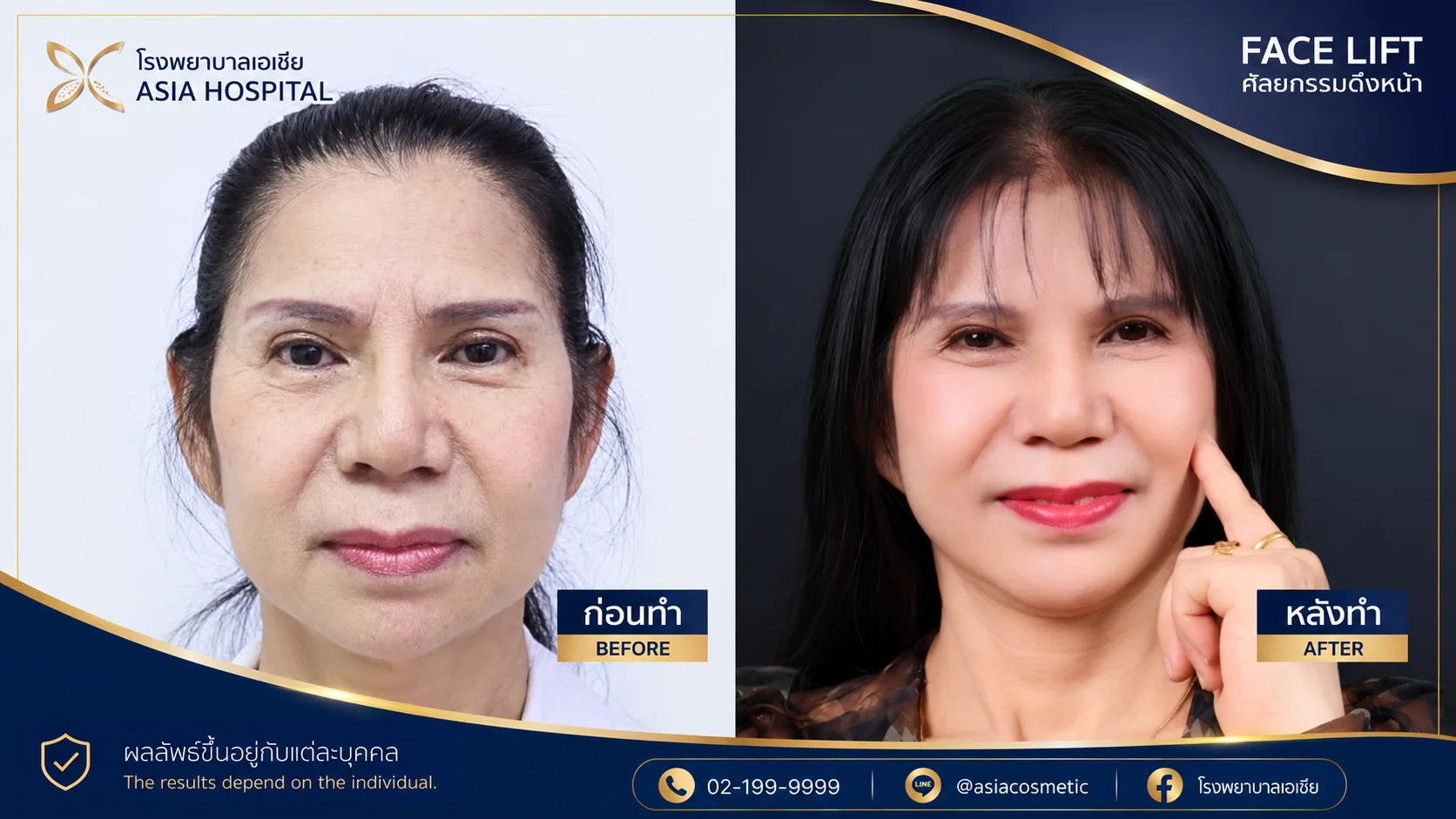 รีวิวดึงหน้า | โรงพยาบาลเอเซีย | โรงพยาบาลเอเซีย รีวิวดึงหน้า Deep Plane Facelift หลังทำ 5 เดือน