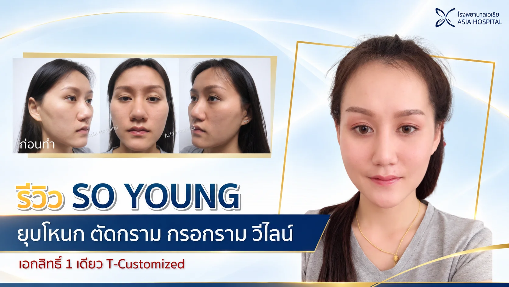 โหนกแก้มสูง-ลดโหนกแก้ม