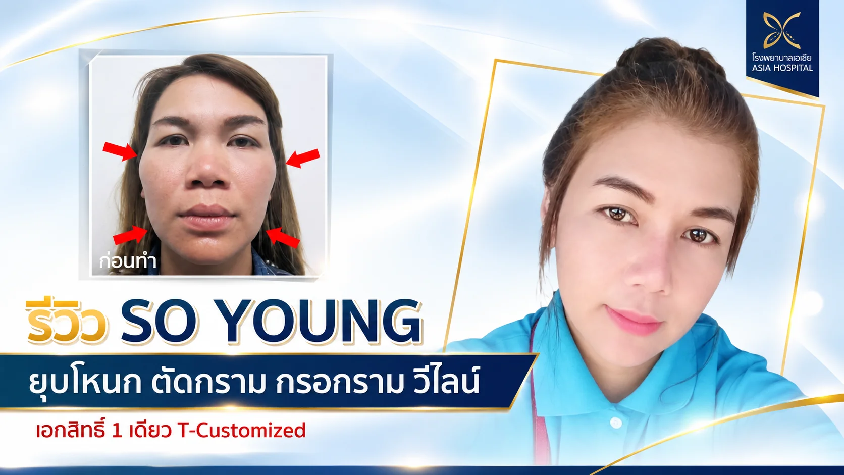 ปรับโครงหน้า-ยุบโหนกแก้ม-ตัดกราม-กรอกราม-วีไลน์