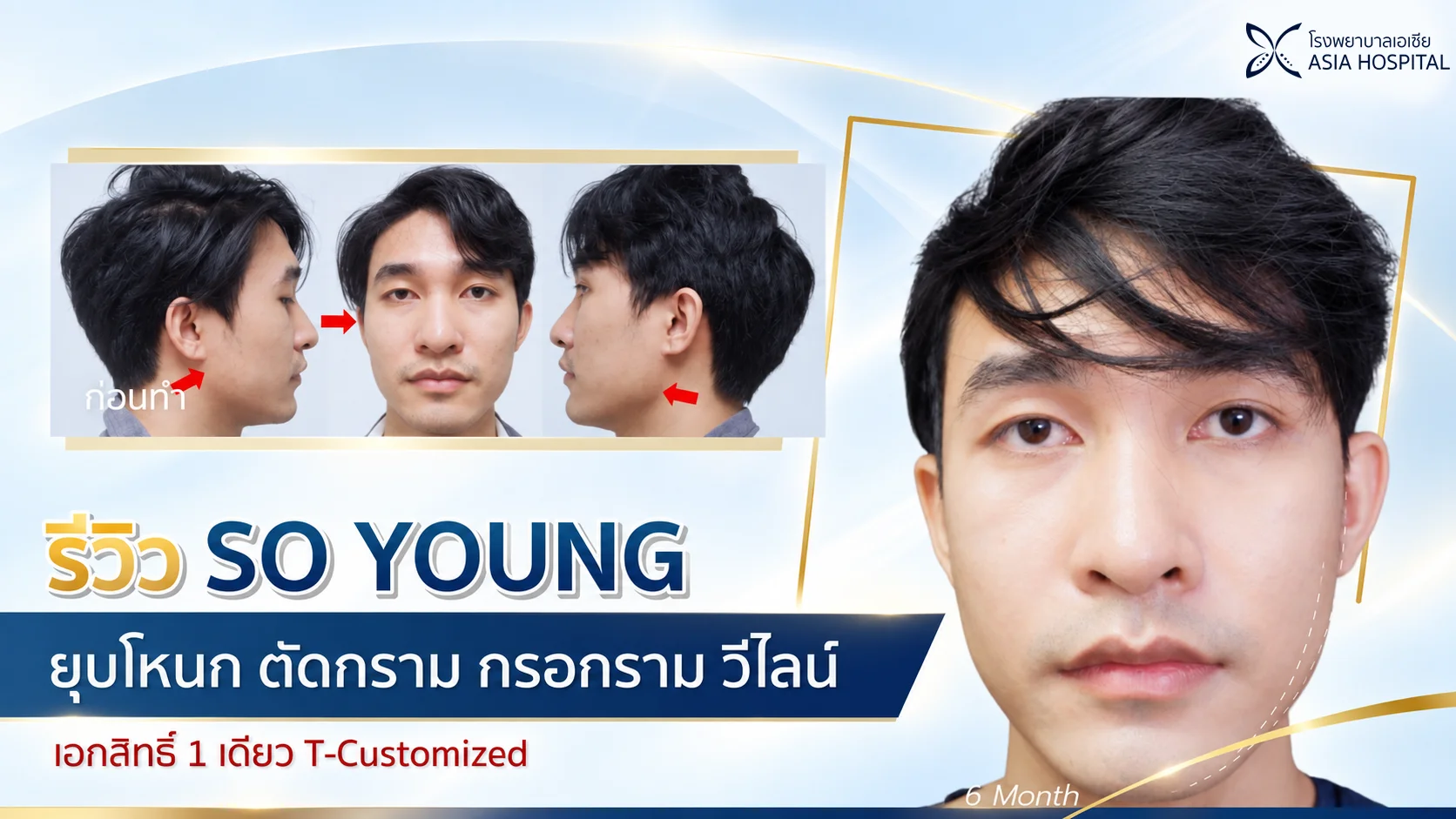 ศัลยกรรมยุบโหนกตัดกรามผู้ชาย