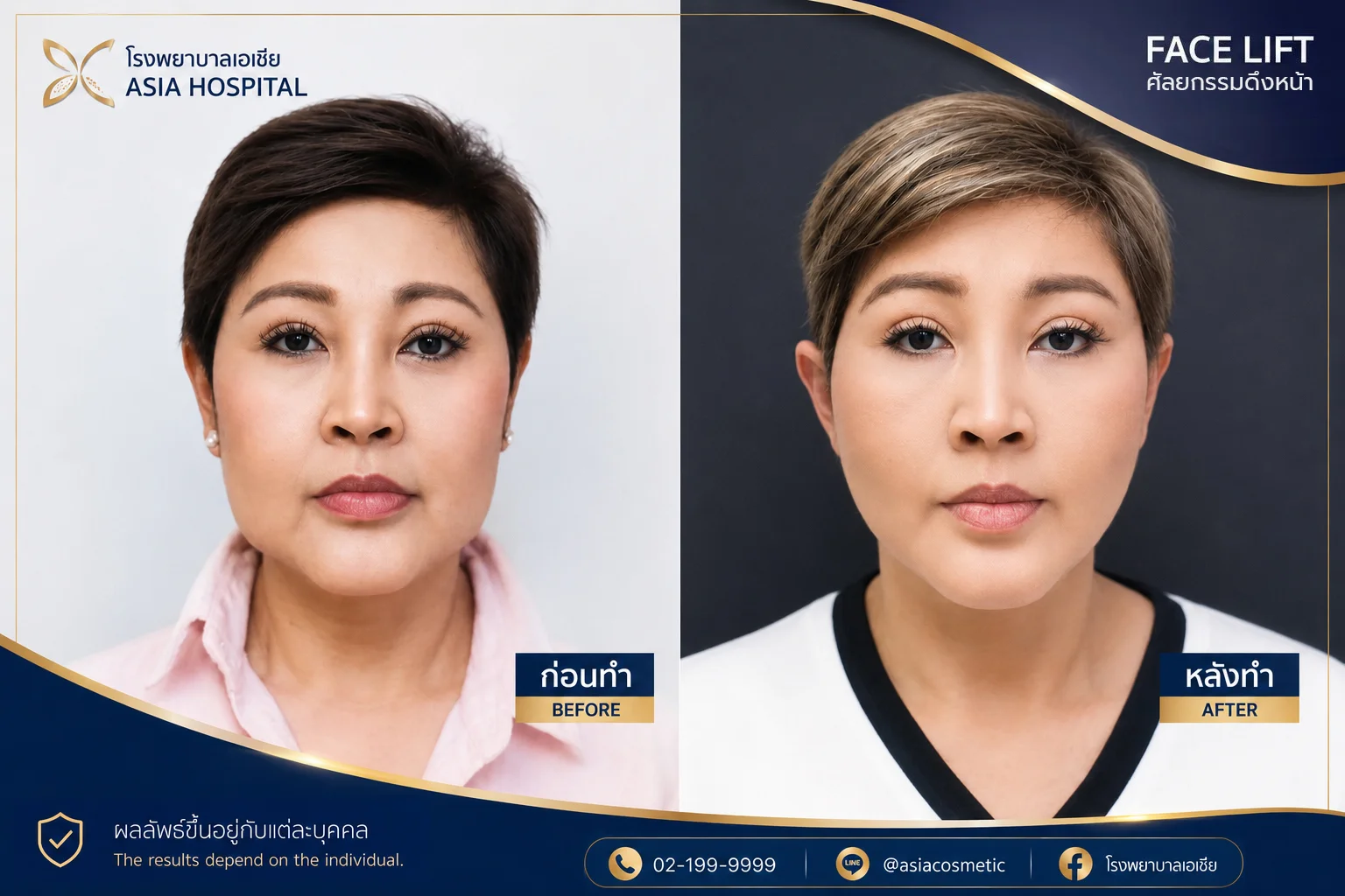 รีวิวดึงหน้า_ดึงหน้า
