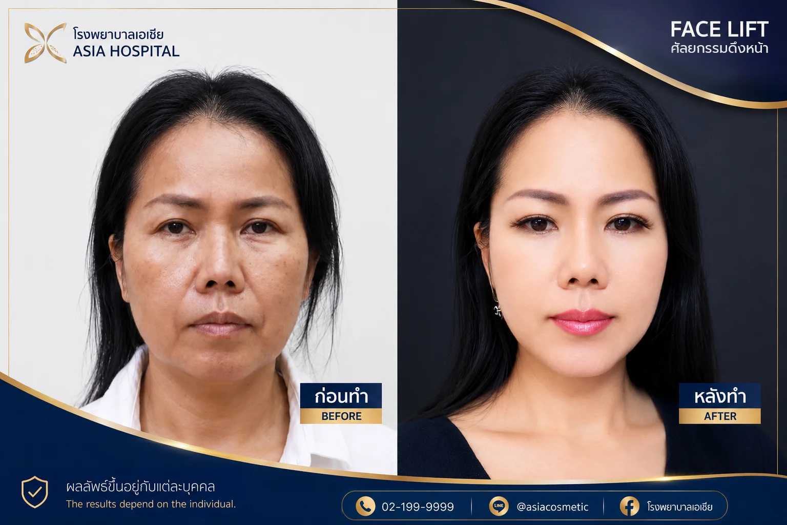 รีวิวดึงหน้า_ดึงหน้า
