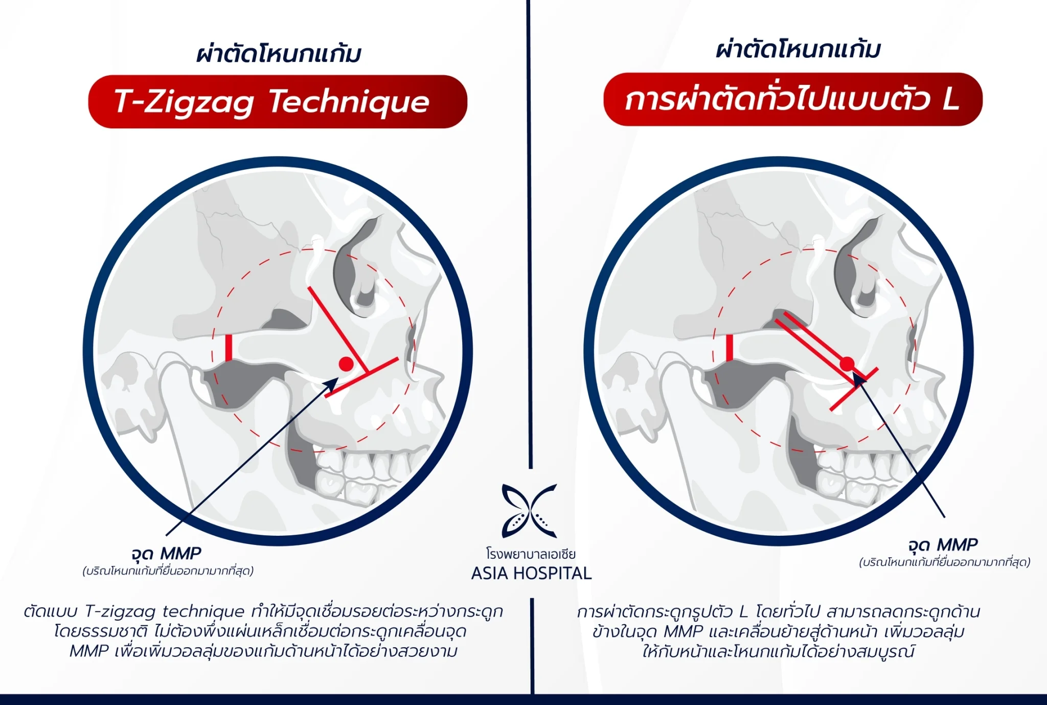 ลดโหนกแก้ม-ยุบโหนกแก้ม