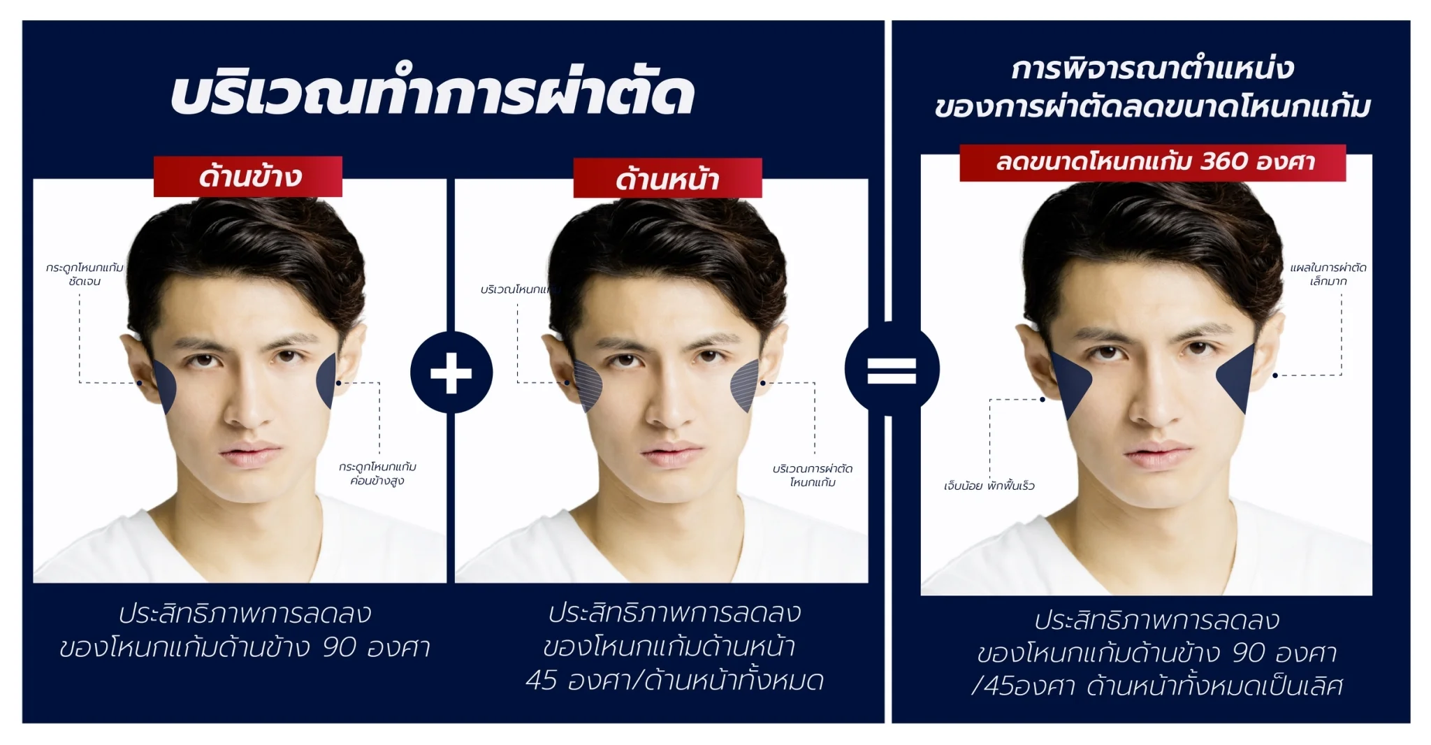 บริเวณที่ผ่าตัด-ยุบโหนกแก้มผู้ชาย
