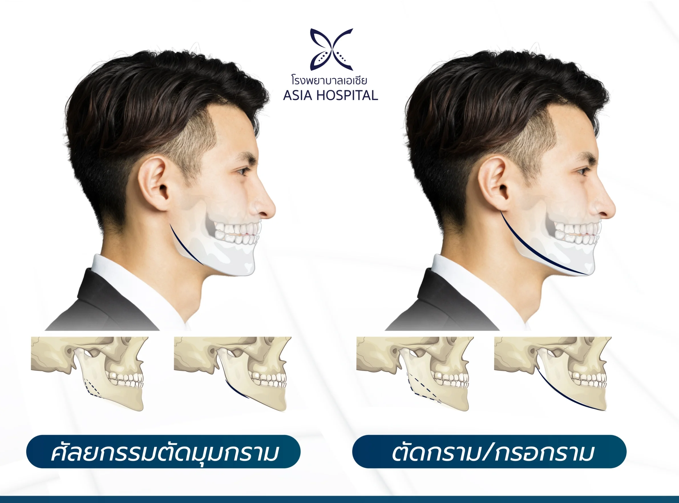 ศัลยกรรมลดมุมกราม ตัดกราม กรอกราม