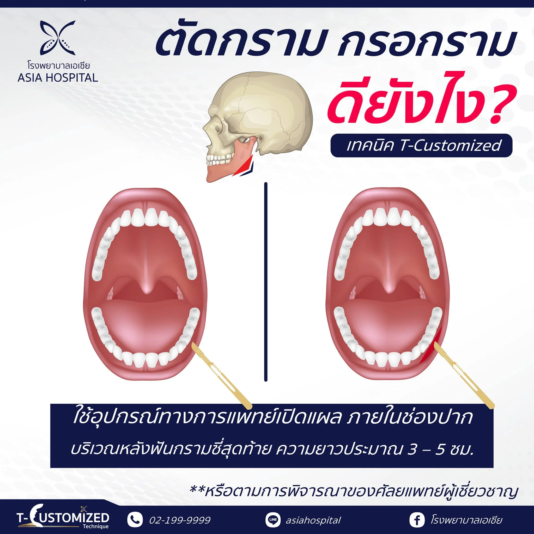 ข้อดีของตัดกราม-กรอกรามผู้ชาย
