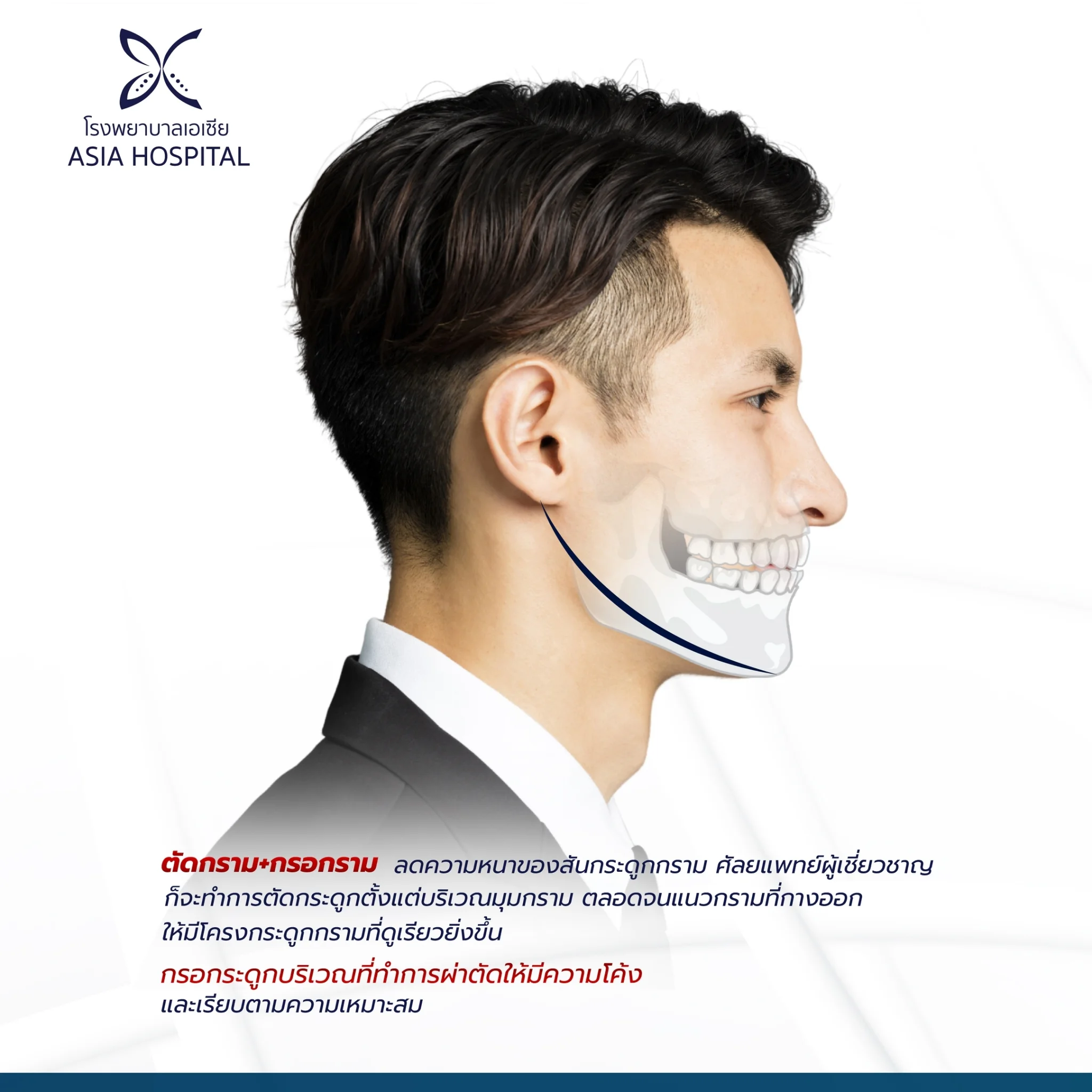 ศัลยกรรมลดมุมกราม ตัดกราม กรอกราม