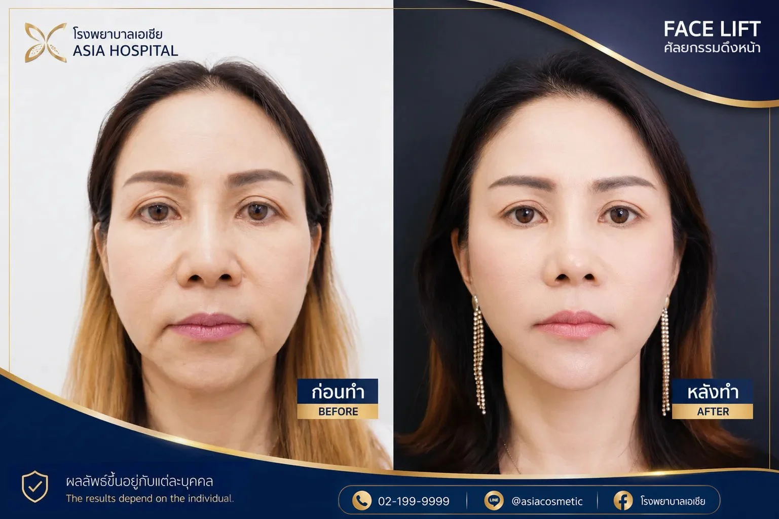 รีวิวดึงหน้า-ดึงหน้าส่วนกลาง-ศัลยกรรมดึงหน้า