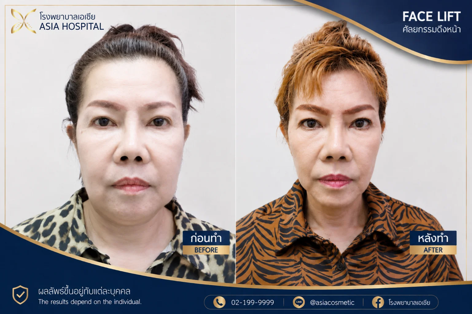 รีวิวดึงหน้า-ดึงหน้าส่วนกลาง