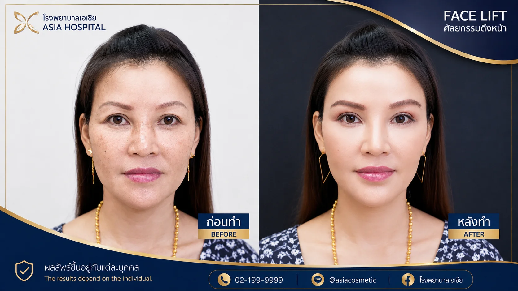 รีวิวดึงหน้าส่วนกลาง
