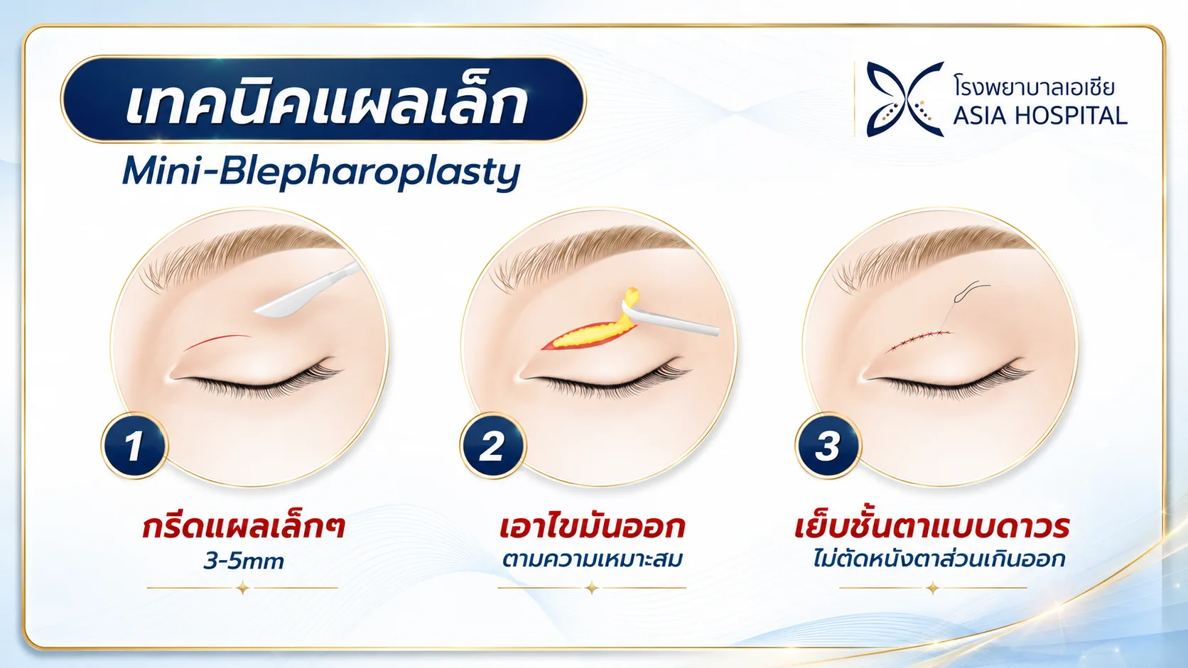 ทำตาสองชั้น-เทคนิคกรีดสั้น-แผลเล็ก