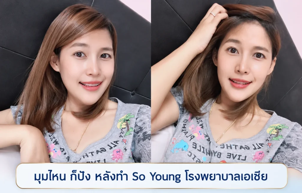 ปรับโครงหน้า ยุบโหนก ตัดกราม