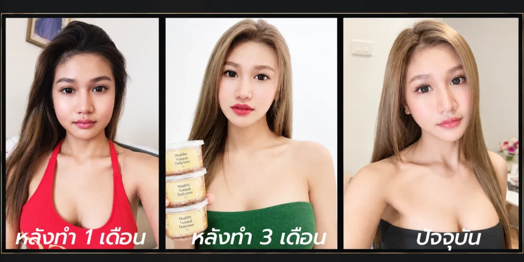 รีวิวยุบโหนกแก้ม-ตัดกราม-ลดโหนกแก้ม