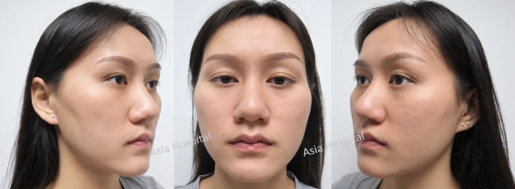 รูปก่อนยุบโหนกแก้ม-ลดโหนกแก้ม