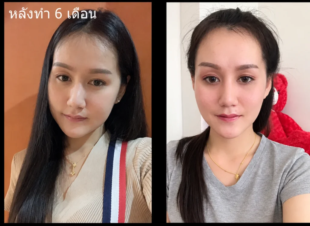 หลังยุบโหนก-ลดโหนกแก้ม-6เดือน