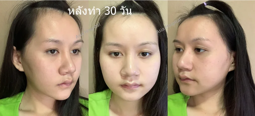 หลังยุบโหนกแก้ม30วัน
