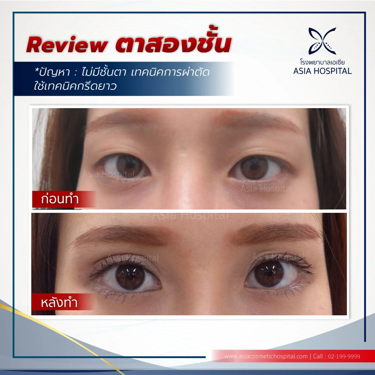 รีวิวทำตาสองชั้น-กรีดยาว