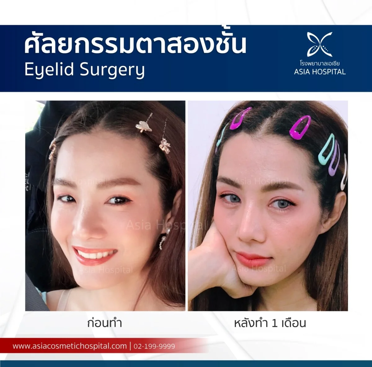 ทำตาสองชั้น-รีวิวทำตาสองชั้น