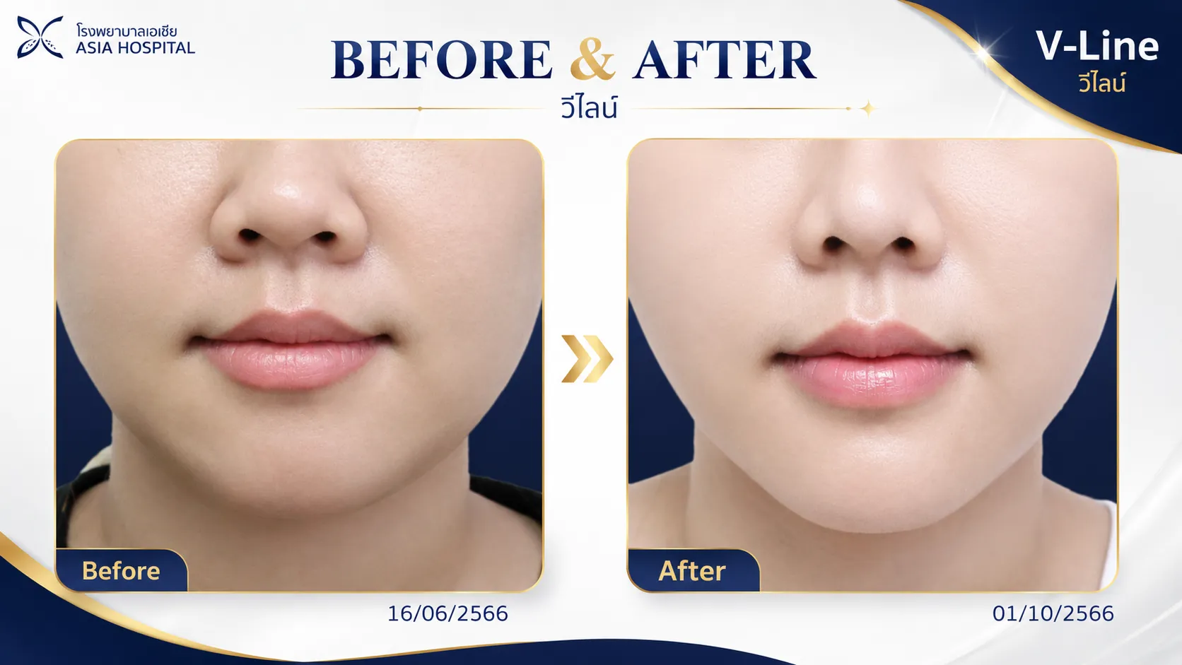รีวิวปรับรูปหน้าวีไลน์