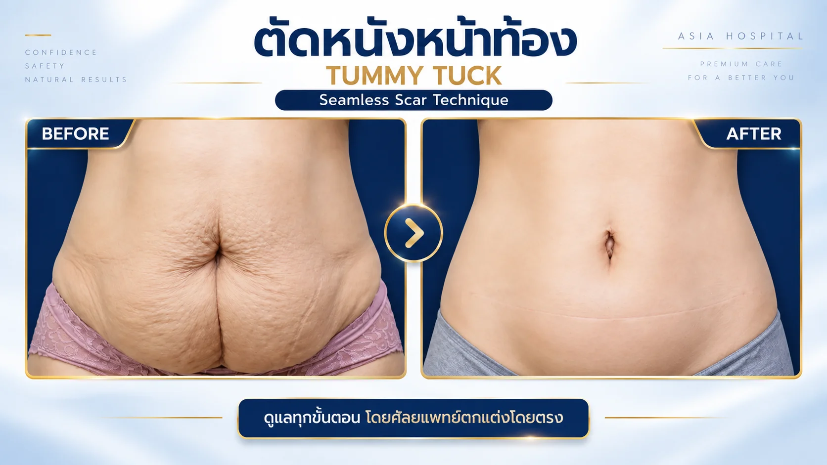 รีวิวตัดหนังหน้าท้อง-ตกแต่งสะดือ